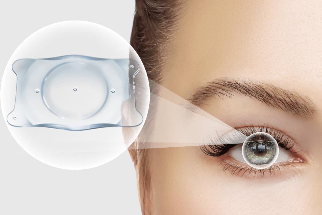 The EVO ICL Next to an Eye