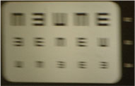 bad astigmatism in boca raton