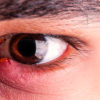Eye Conditions Boca Raton, FL