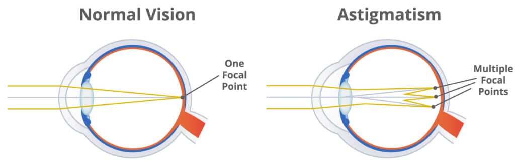 Chart Illustrating normal vision, compared to vision with astigmatism