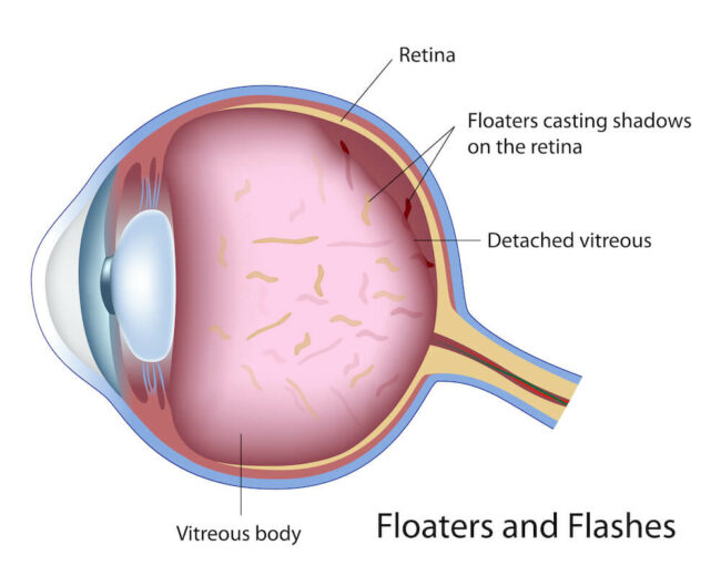 Floaters and Flashed diagram