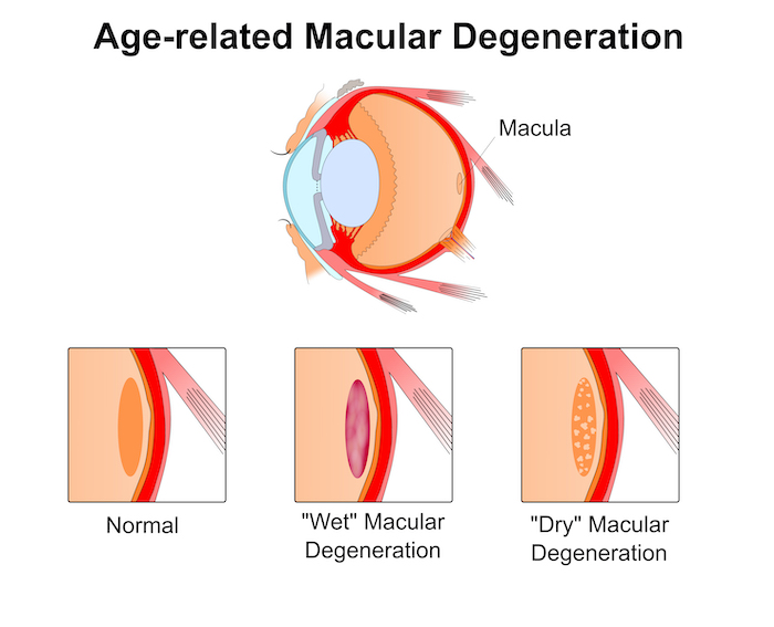 Dry and Wet Macular Degeneration diagram