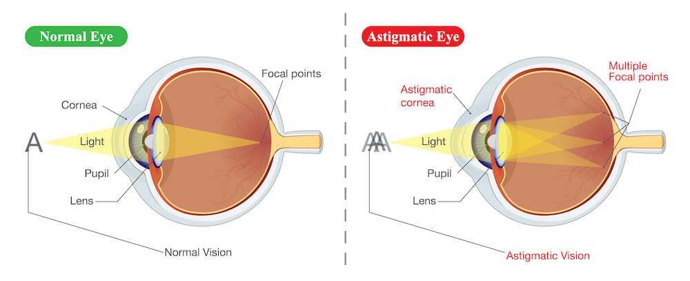 Diagram of astigmatism and normal eye